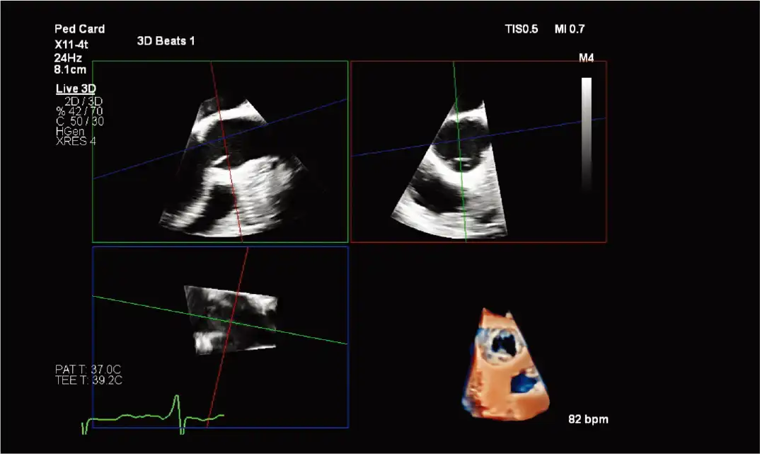 主动脉瓣的 MPR 视图和 TrueVue 容积 主动脉瓣的 MPR 视图和 TrueVue 容积