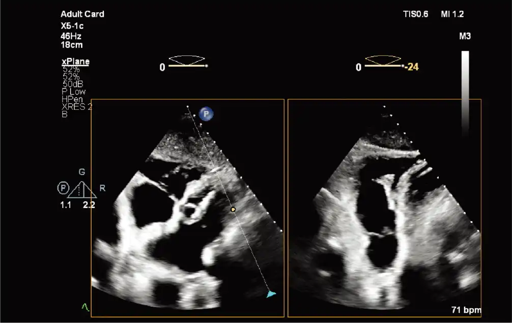 X5-1c 探头肋下 xPlane 肺动脉图像 X5-1c 探头肋下 xPlane 肺动脉图像