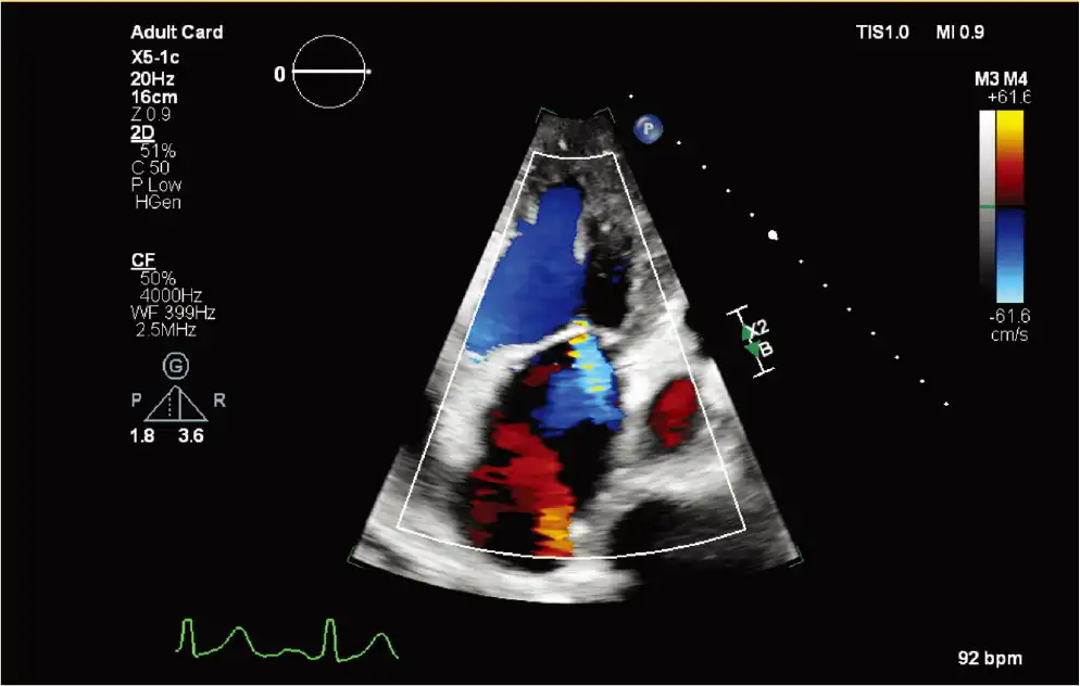 X5-1c 探头彩色多普勒二尖瓣返流(MR) X5-1c 探头彩色多普勒二尖瓣返流(MR)