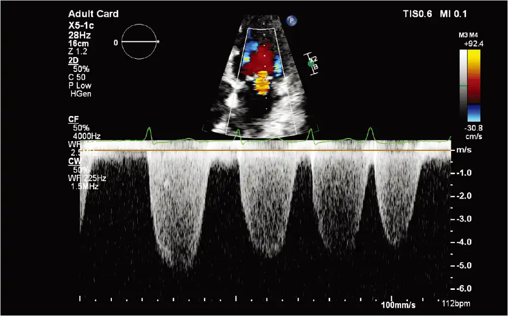 X5-1c 磁共振 CW 多普勒探头 X5-1c 磁共振 CW 多普勒探头