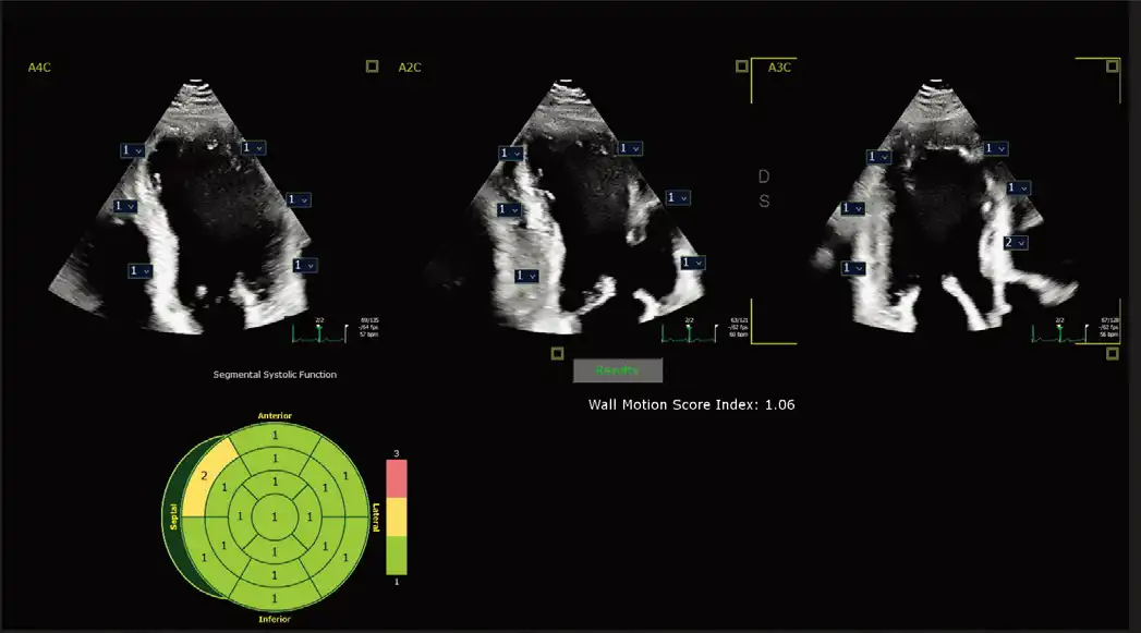 X5-1c 探头进行自动节段性室壁运动评分指数 X5-1c 探头进行自动节段性室壁运动评分指数