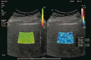 肝纤维化ElastQ显示组织硬度值升高 肝纤维化ElastQ显示组织硬度值升高