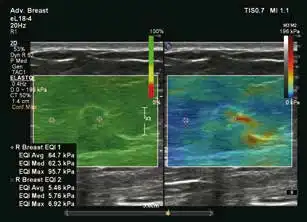 ElastQ显示病灶周边组织硬度增高