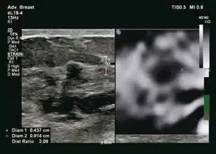 乳腺癌的应变弹性成像中E/B比值大于1 乳腺癌的应变弹性成像中E/B比值大于1