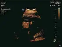 超声造影 超声造影