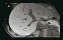 超声融合介入导航