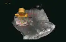 超声融合介入导航