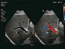 彩色血流 彩色血流