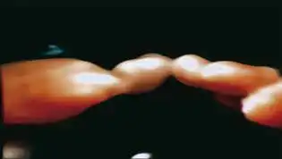 颈总动脉狭窄 颈总动脉狭窄