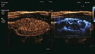 淋巴结双微造影模式