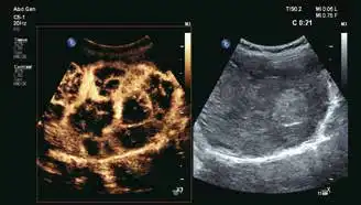 肝脏超声造影 肝脏超声造影