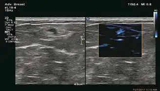 乳腺结节MFI显示其内部血流