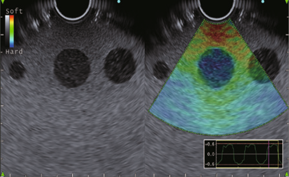 Elastography