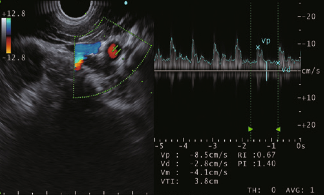 Pulsed Wave Doppler