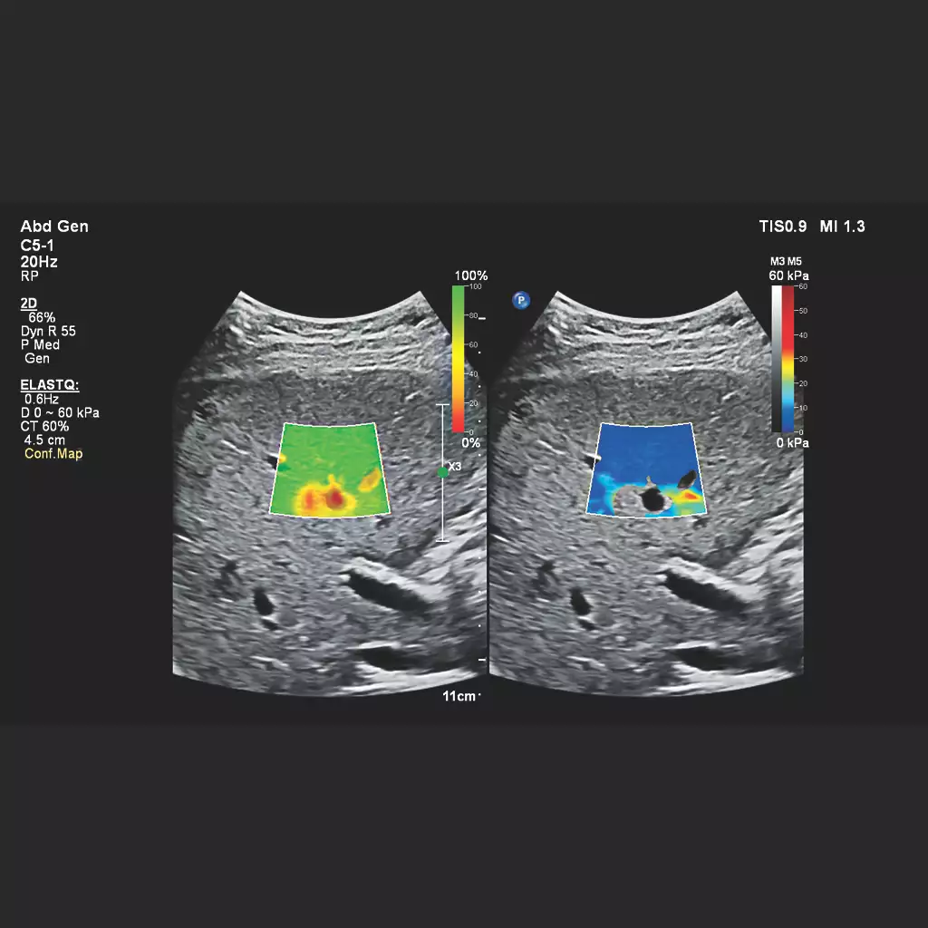 Elastography