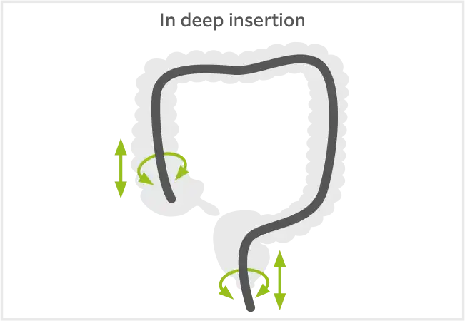 In deep insertion