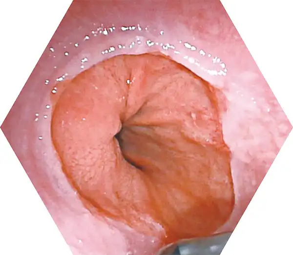 内窥镜视角 Endoscopic Viewing Angle