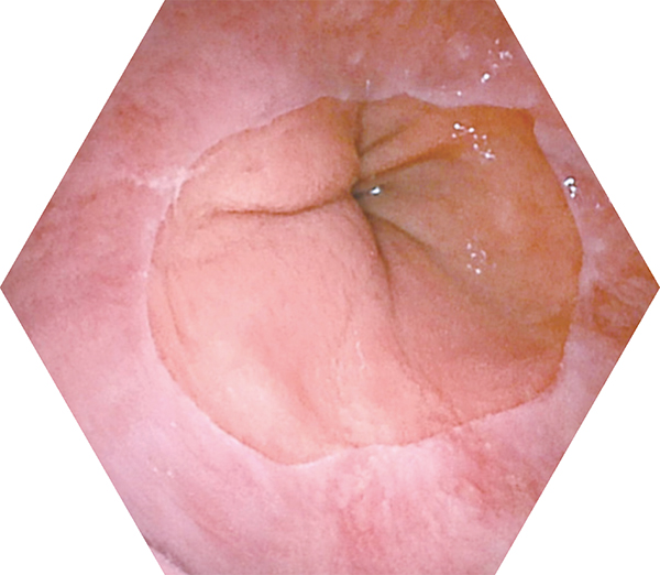 内窥镜视角 Endoscopic Viewing Angle