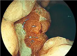 FICE 1 胃 FICE 1 胃