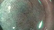 NBI (Narrow Band Imaging)