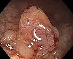 正常对焦模式 Normal focus mode
