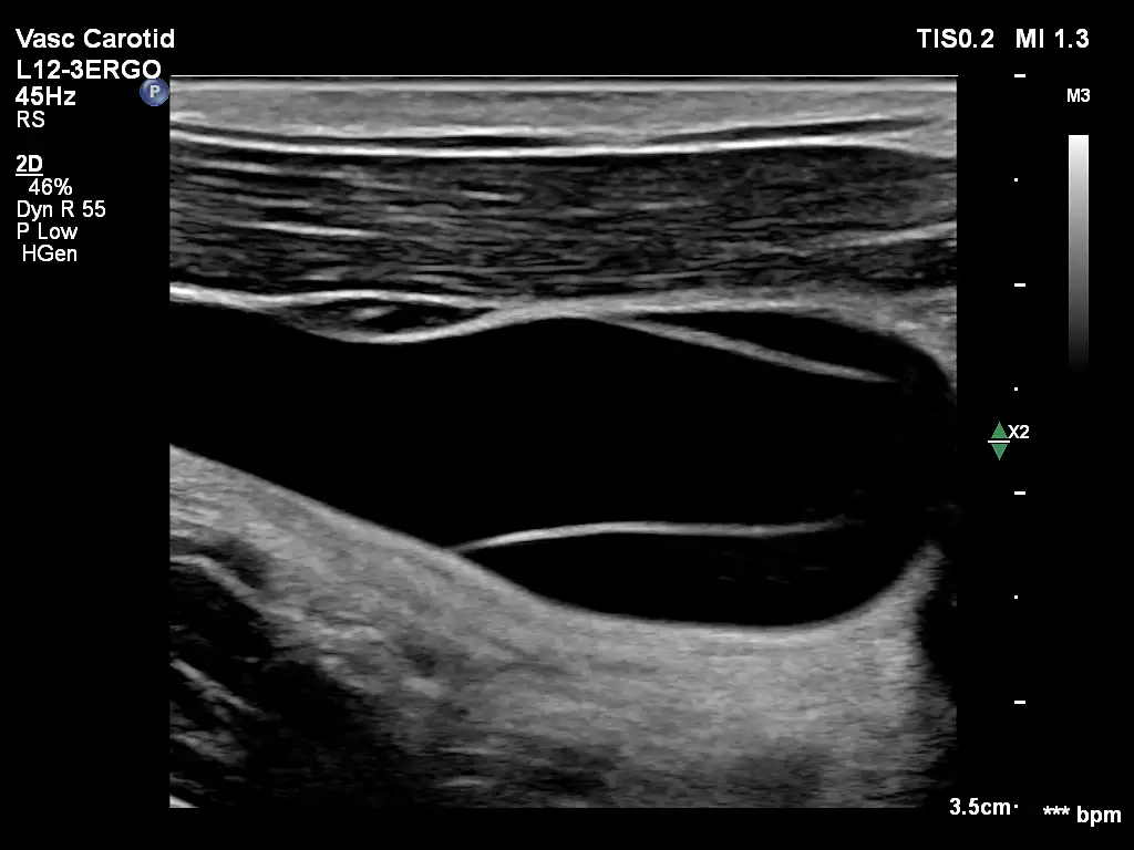 L12-3ERGO Internal Jugular Vein