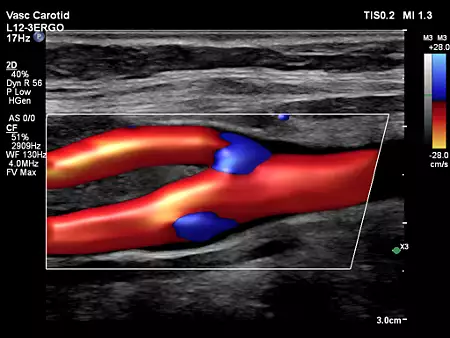 L12-3ERGO Vascular Carotid Flow Viewer Color
