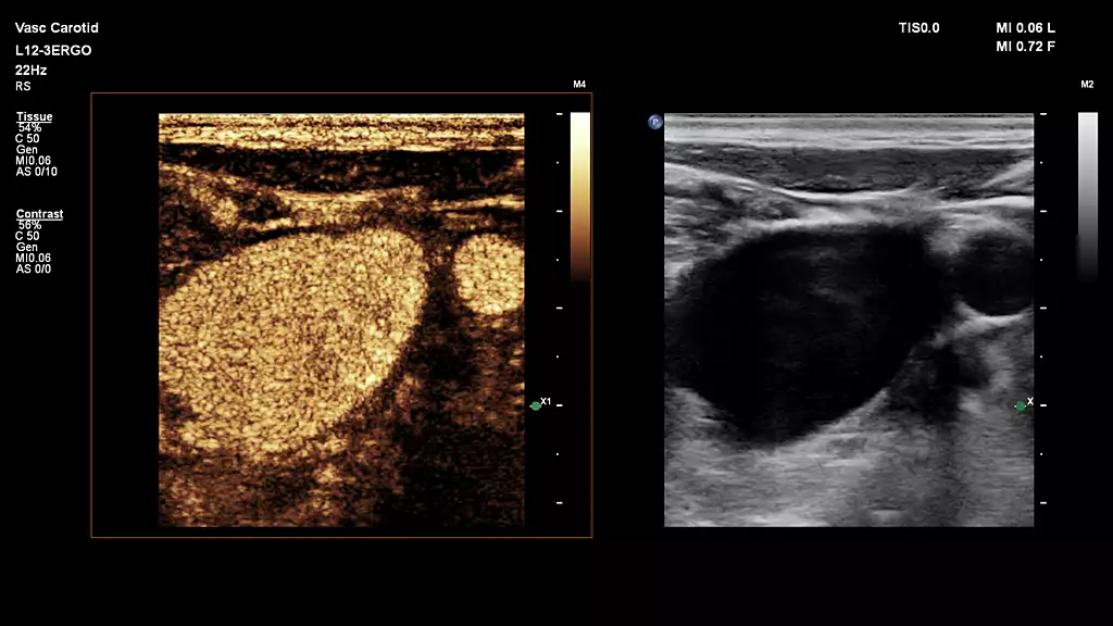 L12-3 paired with CEUS Auto Scan, scanning on the Vascular Carotid Preset