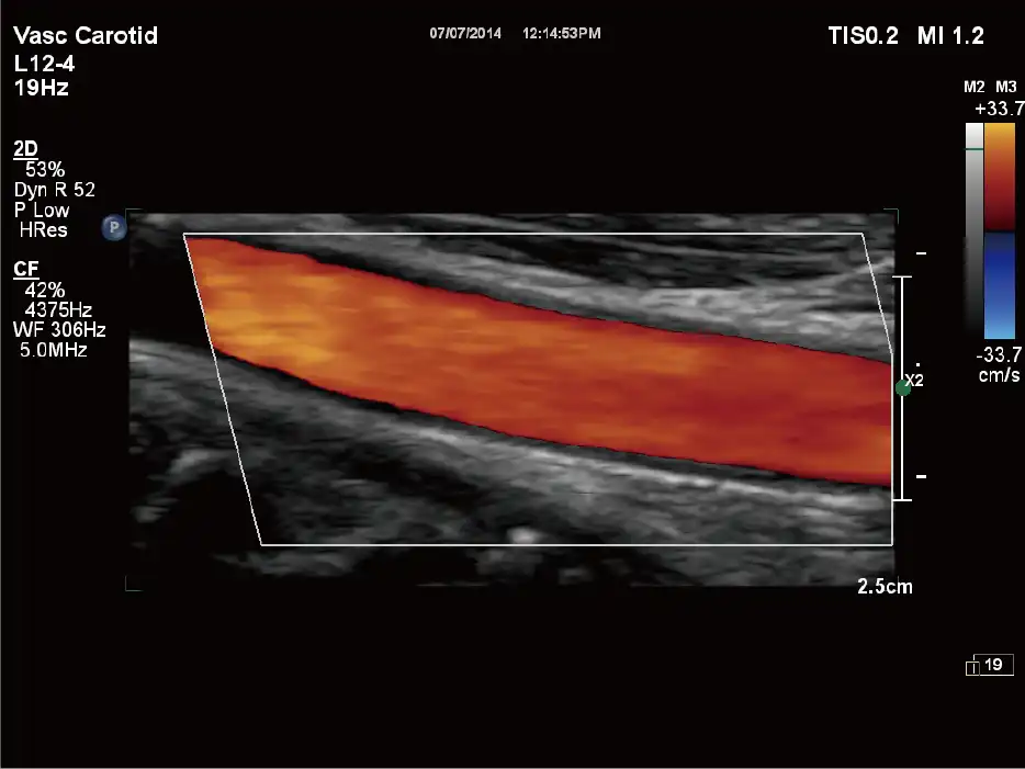 L12-4探头显示颈动脉血流