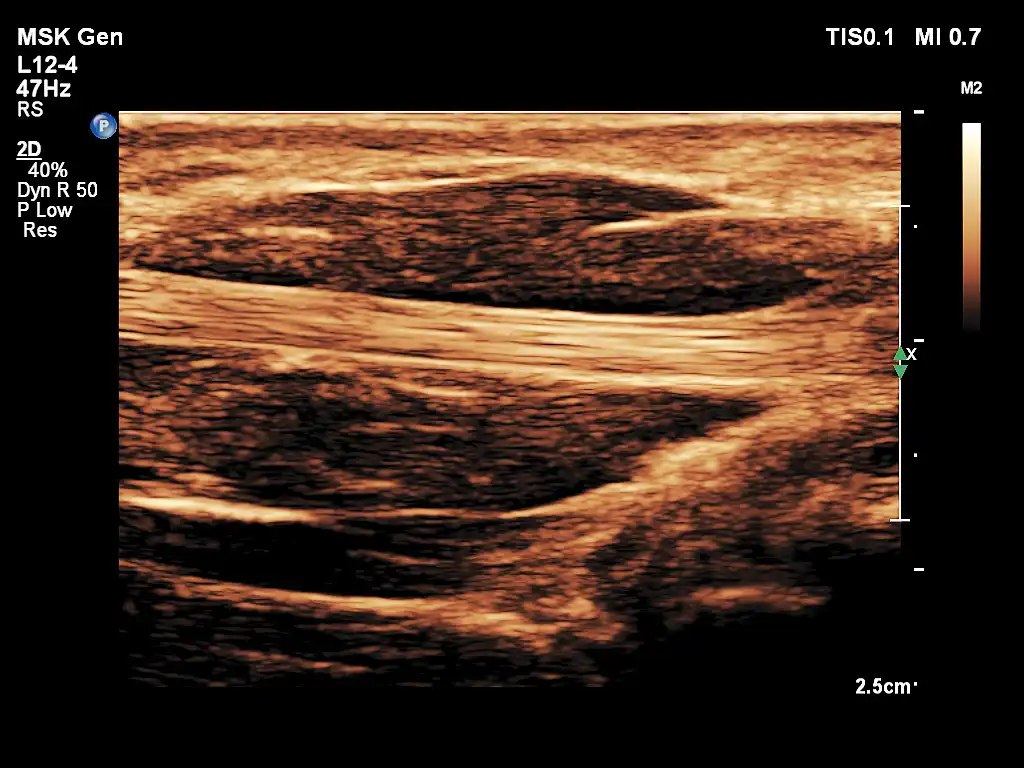 L12-4探头显示肌腱