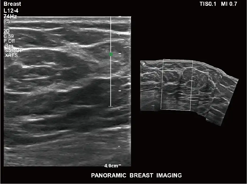 L12-4探头显示乳腺的全景成像