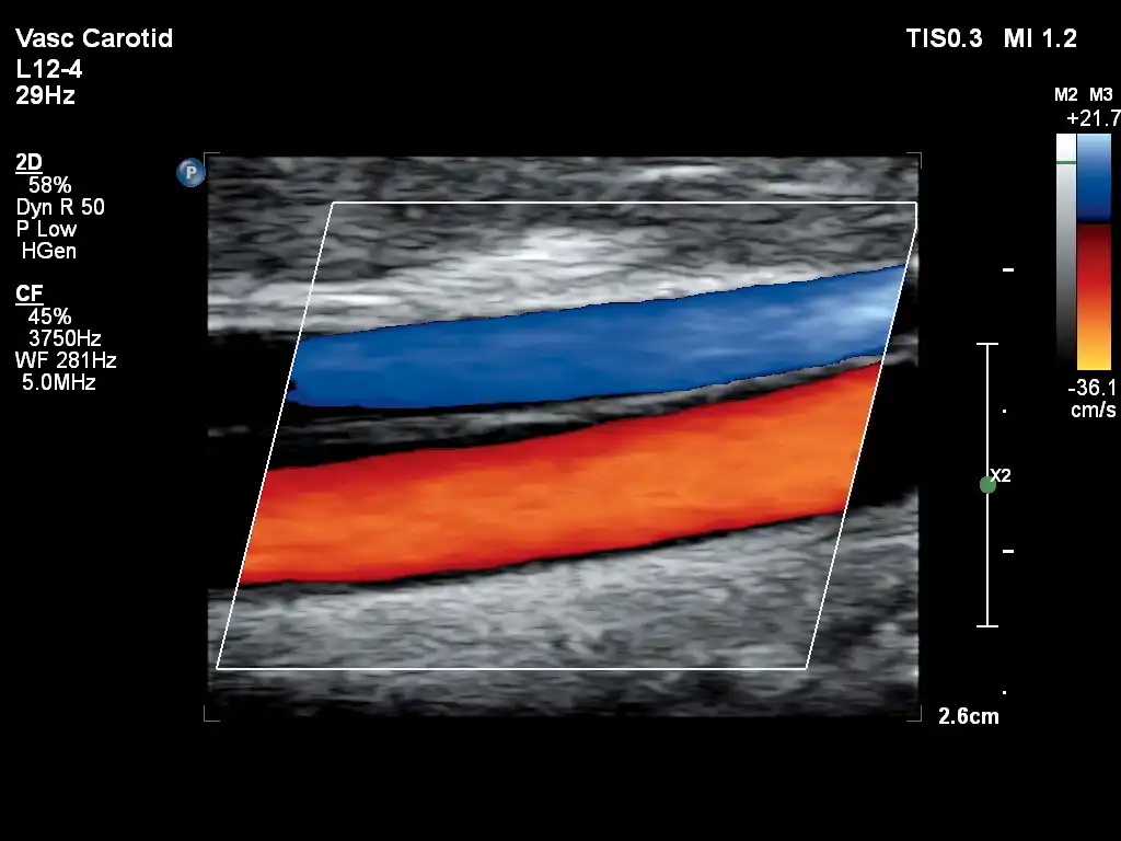 L12-4探头显示颈总动脉和颈静脉 L12-4探头显示颈总动脉和颈静脉