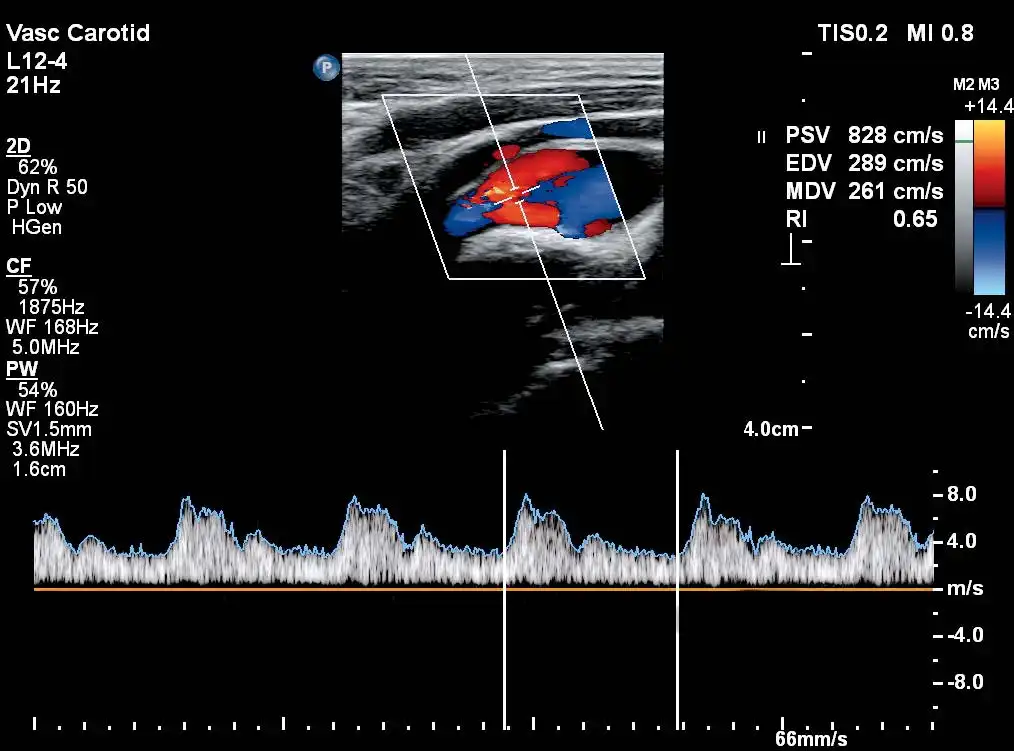 L12-4探头显示颈动脉分叉