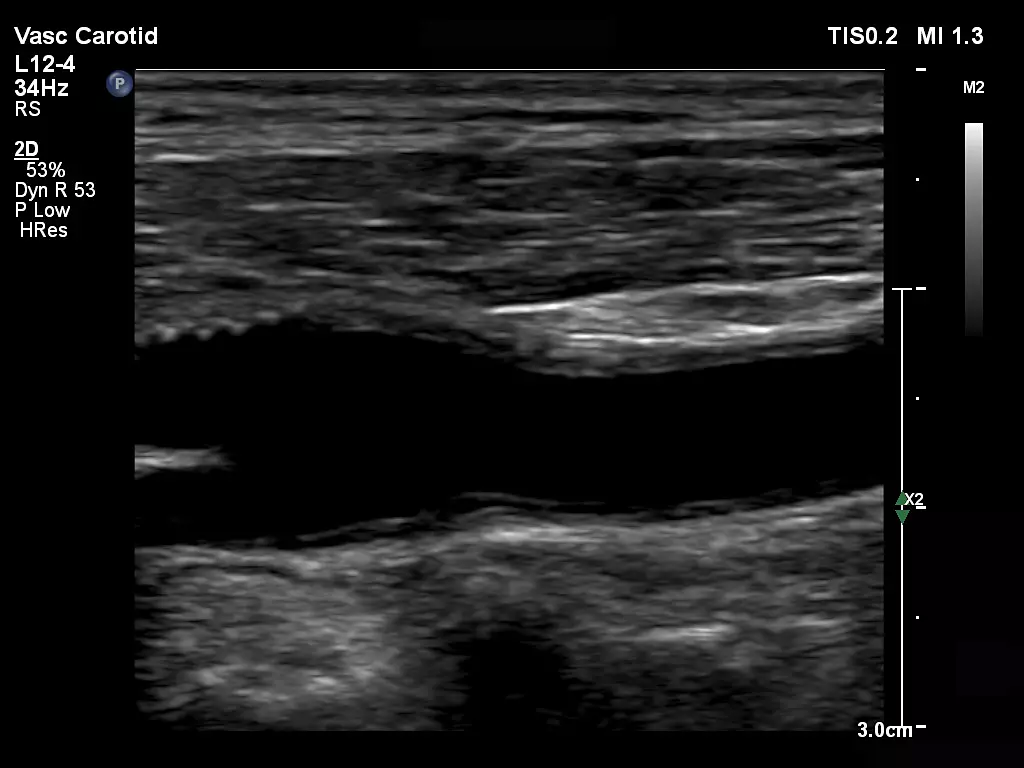 L12-4 Vascular Carotid