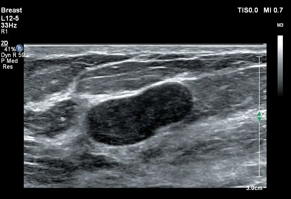 L12-5探头显示乳腺纤维腺瘤