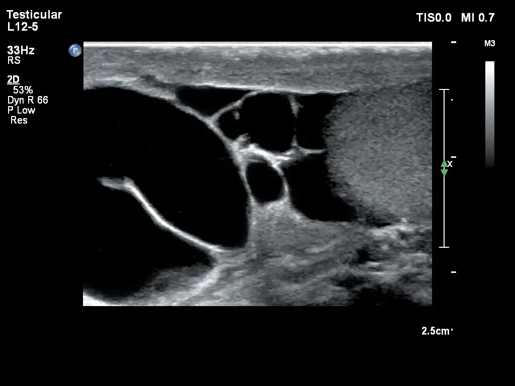 L12-5探头显示睾丸 L12-5探头显示睾丸