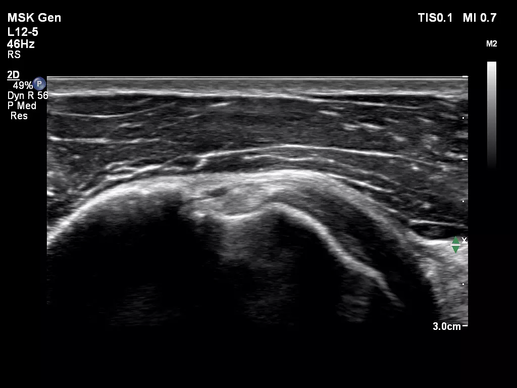 L12-5 MSK Biceps Tendon