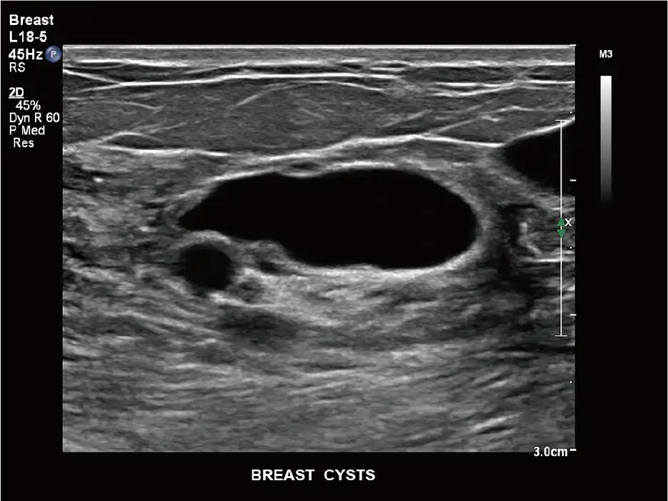 L18-5探头显示乳腺囊肿