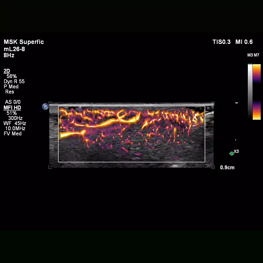 MFI HD