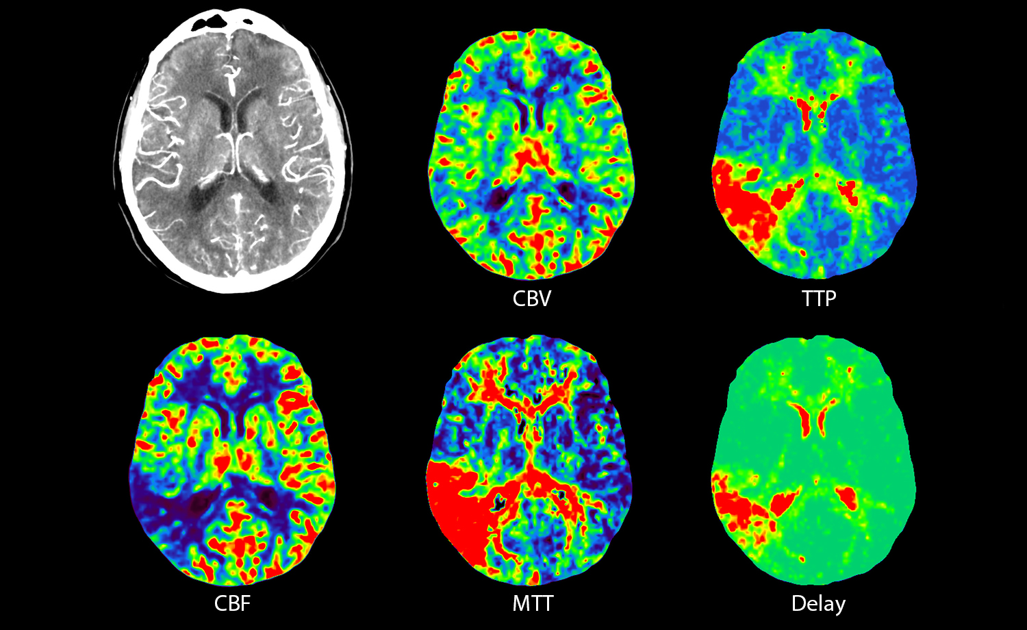 Neuro CT