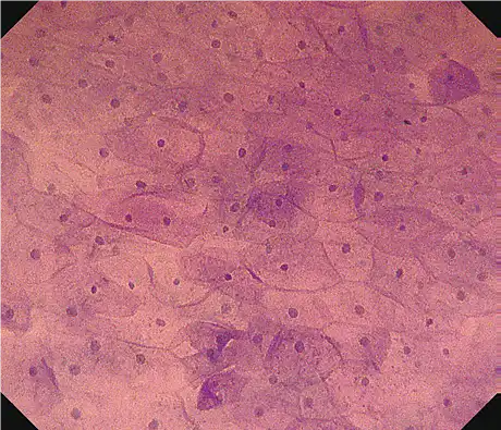 Nontumor (esophagus) Nontumor (esophagus)