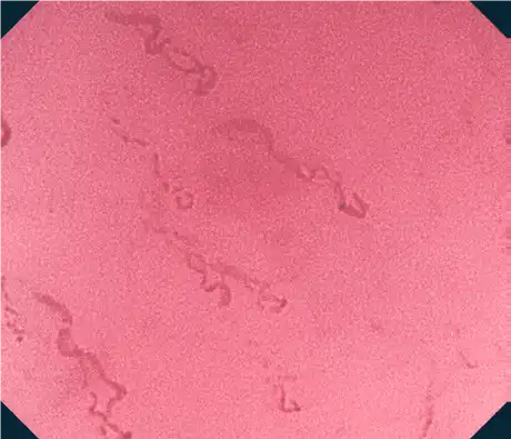 Nontumor (esophagus) Nontumor (esophagus)