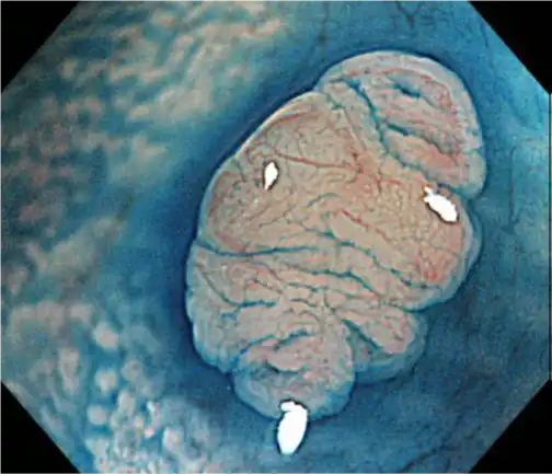 光学变焦 + NBI 光学变焦+ Dye spray