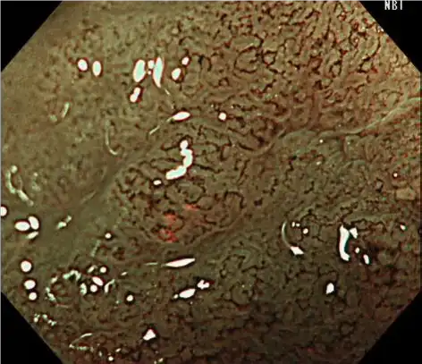 光学变焦+ Dye spray 光学变焦 + NBI