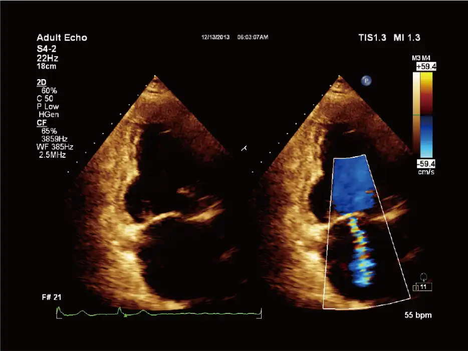 S4-2探头显示二尖瓣返流 S4-2探头显示二尖瓣返流