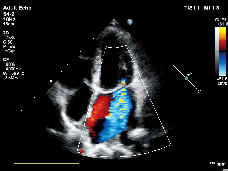 S4-2探头显示四腔心 S4-2探头显示四腔心