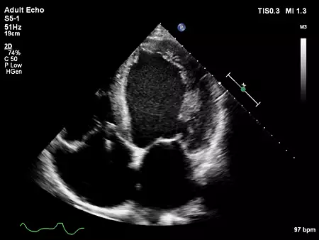 S5-1 Adult Echo