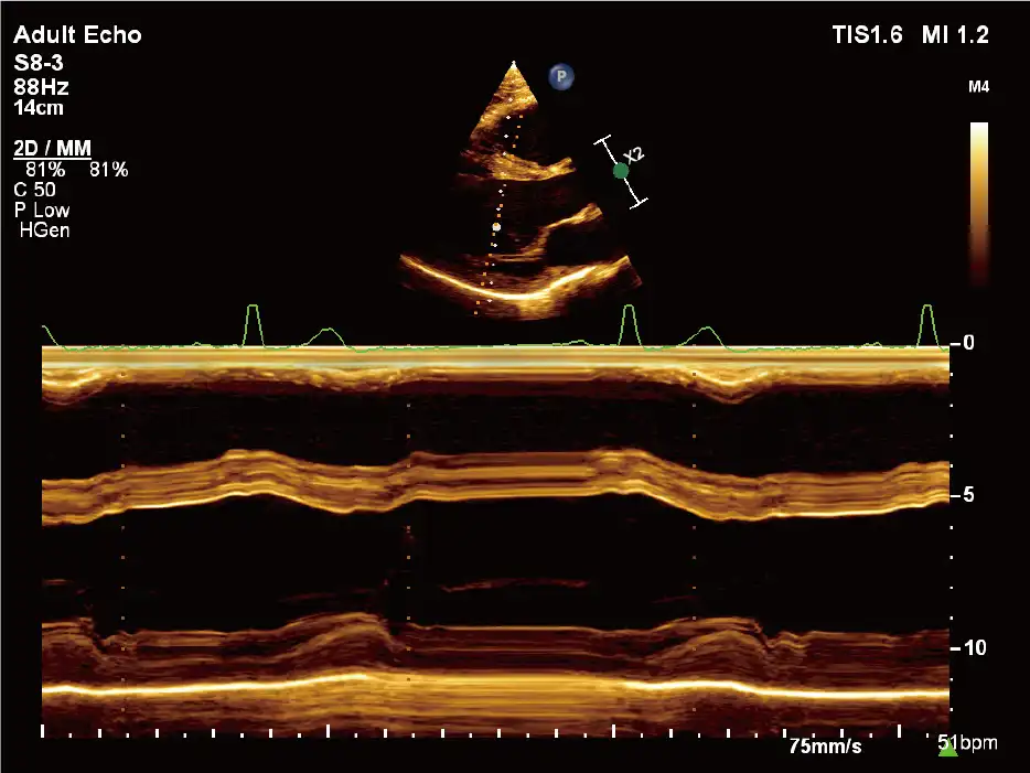 S8-3探头显示心脏(解剖M型) S8-3探头显示心脏(解剖M型)