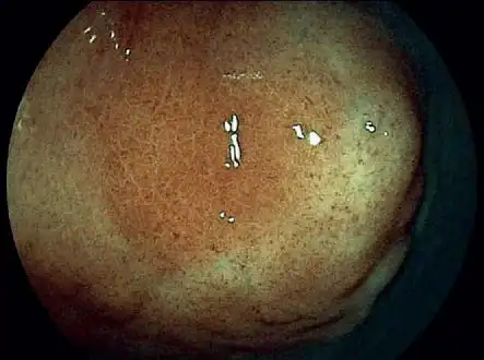 肠绒毛的FICE图像 胃的FICE图像