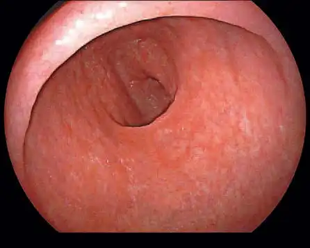 肠绒毛的白光图像 胃的白光图像